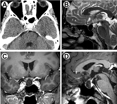 Case report: A rare case of thyrotropin-secreting pituitary macroadenoma with diffuse calcification presenting with hyperthyroidism and literature review